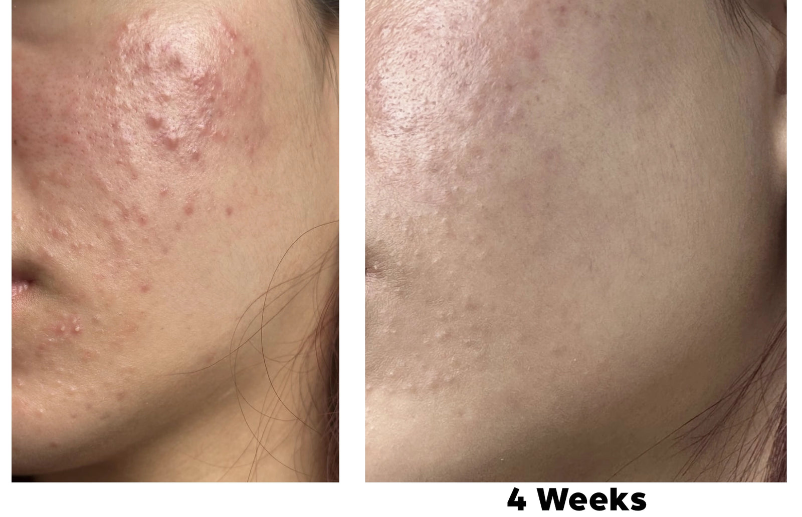 bareLUXE Oil for oily and acne prone skin - before and after photos